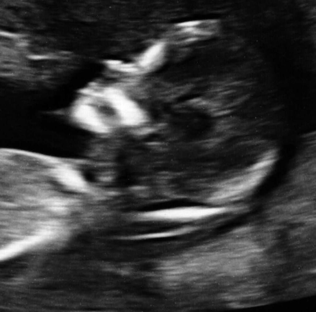 Ultrasound Ultrasound