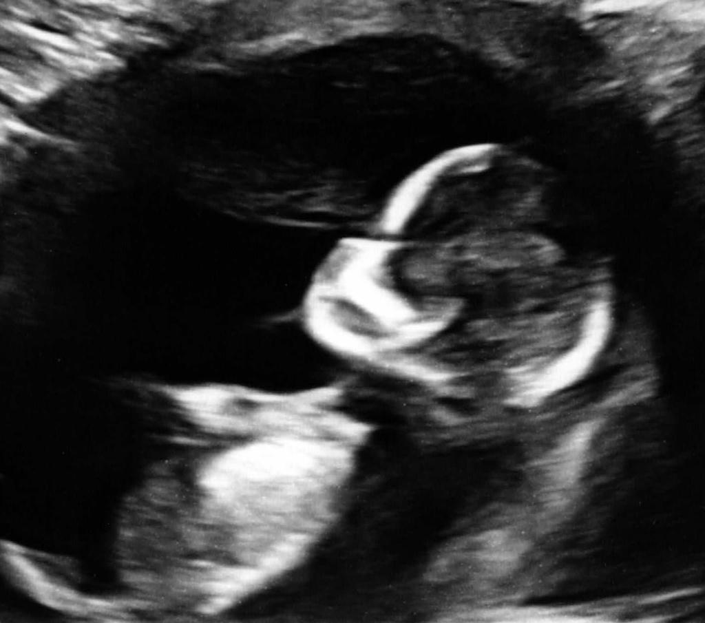 Ultrasound Ultrasound